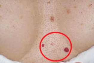 Você tem esses pontos vermelhos em algum lugar do corpo? Descubra o que são e como surgem!